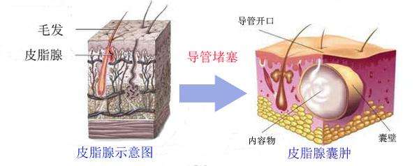 皮脂腺囊肿和痤疮的治疗差异(图1)