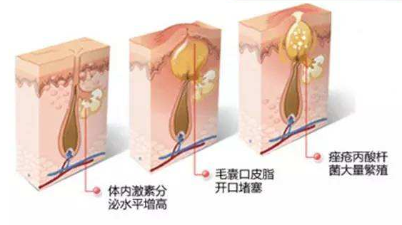 皮脂腺囊肿和痤疮的治疗差异(图2)