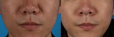活肤焕颜中胚层技术，对黄褐斑合并炎症色沉方案分享(图2)