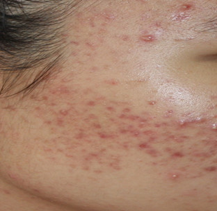 丘疹性痤疮和闭合性粉刺(图2)