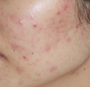 闭合性粉刺和丘疹性痤疮（炎症期.中度）(图2)